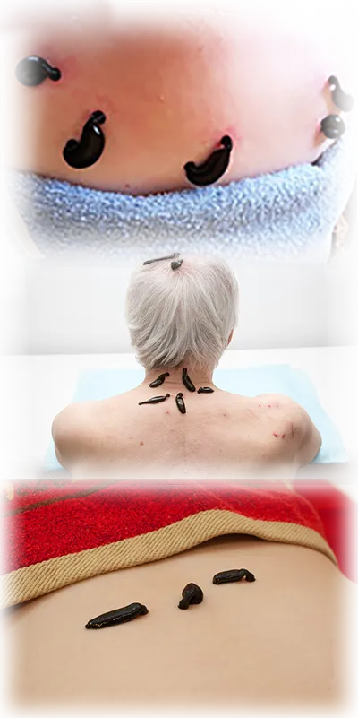 Medizinischer Blutegel bei einer Blutegeltherapie